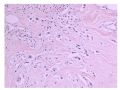 少见病例——乳腺组织细胞-肌母细胞样癌图9