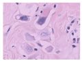 少见病例——乳腺组织细胞-肌母细胞样癌图10