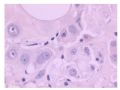 少见病例——乳腺组织细胞-肌母细胞样癌图11