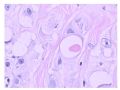 少见病例——乳腺组织细胞-肌母细胞样癌图12