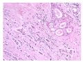 少见病例——乳腺组织细胞-肌母细胞样癌图14