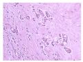 少见病例——乳腺组织细胞-肌母细胞样癌图15
