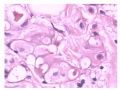 少见病例——乳腺组织细胞-肌母细胞样癌图16