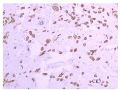 少见病例——乳腺组织细胞-肌母细胞样癌图17