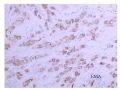 少见病例——乳腺组织细胞-肌母细胞样癌图18