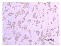 少见病例——乳腺组织细胞-肌母细胞样癌图19