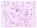 少见病例——乳腺组织细胞-肌母细胞样癌图20