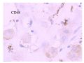 少见病例——乳腺组织细胞-肌母细胞样癌图21