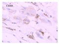 少见病例——乳腺组织细胞-肌母细胞样癌图22