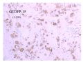 少见病例——乳腺组织细胞-肌母细胞样癌图23