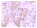 少见病例——乳腺组织细胞-肌母细胞样癌图24