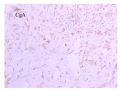 少见病例——乳腺组织细胞-肌母细胞样癌图25