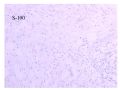少见病例——乳腺组织细胞-肌母细胞样癌图27