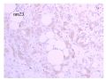 少见病例——乳腺组织细胞-肌母细胞样癌图28