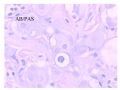 少见病例——乳腺组织细胞-肌母细胞样癌图29