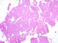 子宫刮出物_胎盘部位滋养细胞肿瘤(placental site trophoblastic tumor)图1