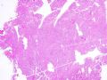 子宫刮出物_胎盘部位滋养细胞肿瘤(placental site trophoblastic tumor)图2