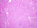 子宫刮出物_胎盘部位滋养细胞肿瘤(placental site trophoblastic tumor)图3
