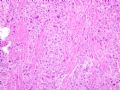 子宫刮出物_胎盘部位滋养细胞肿瘤(placental site trophoblastic tumor)图4
