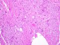 子宫刮出物_胎盘部位滋养细胞肿瘤(placental site trophoblastic tumor)图5