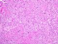 子宫刮出物_胎盘部位滋养细胞肿瘤(placental site trophoblastic tumor)图6