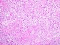 子宫刮出物_胎盘部位滋养细胞肿瘤(placental site trophoblastic tumor)图7