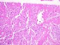 子宫刮出物_胎盘部位滋养细胞肿瘤(placental site trophoblastic tumor)图8