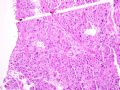 子宫刮出物_胎盘部位滋养细胞肿瘤(placental site trophoblastic tumor)图9