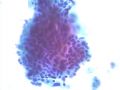 宫颈液基细胞学特殊病例图1