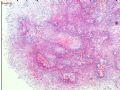卵巢畸胎瘤图3