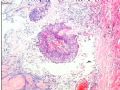 卵巢畸胎瘤图4