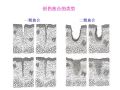 病理学2-第二章 损伤的修复图26