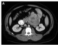 36 year old man a with duodenal mass（M36Y，十二指肠肿块）图1