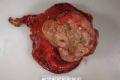 36 year old man a with duodenal mass（M36Y，十二指肠肿块）图2