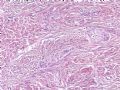 欣赏-卵巢肿瘤图2