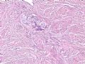 欣赏-卵巢肿瘤图3