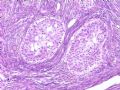 欣赏-卵巢肿瘤图5