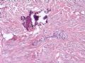 欣赏-卵巢肿瘤图8