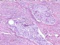 欣赏-卵巢肿瘤图9