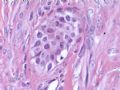 欣赏-卵巢肿瘤图10