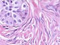 欣赏-卵巢肿瘤图12