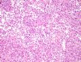 [已确诊] 肺肿瘤_1 (lung tumor-1)- malignant melanoma 恶性黑色素瘤图5