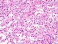 [已确诊] 肺肿瘤_1 (lung tumor-1)- malignant melanoma 恶性黑色素瘤图7
