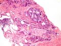 [已确诊]前列腺病变_2 (prostate lesion 2)-前列腺腺泡癌伴神经浸润, 扩展到前列腺外面图3