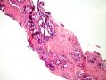 [已确诊]前列腺病变_2 (prostate lesion 2)-前列腺腺泡癌伴神经浸润, 扩展到前列腺外面图4