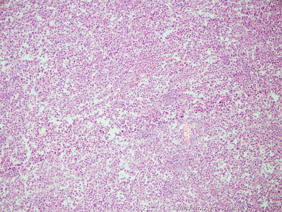  1 lung Tumor 1 Malignant Melanoma 