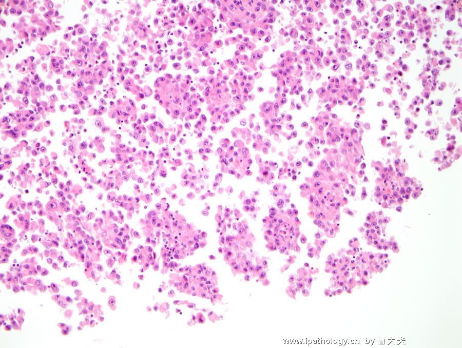 1-lung-tumor-1-malignant-melanoma