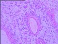 右颞叶胶质母细胞瘤？图4