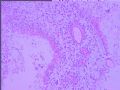 右颞叶胶质母细胞瘤？图5