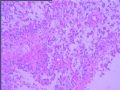 右颞叶胶质母细胞瘤？图6